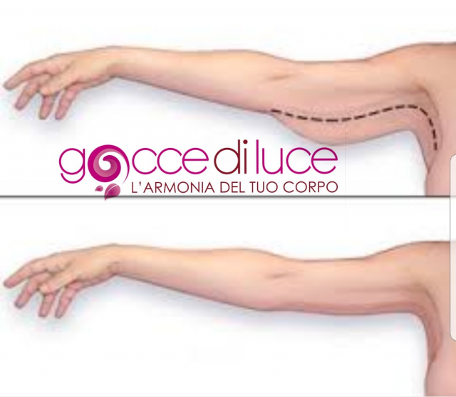 6 radiofrequenza braccia